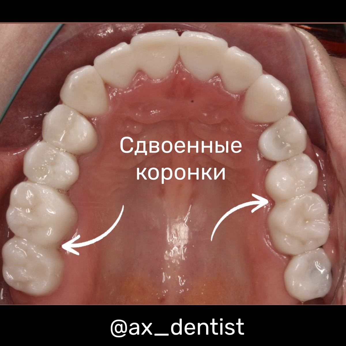 Пример сдвоенных коронок