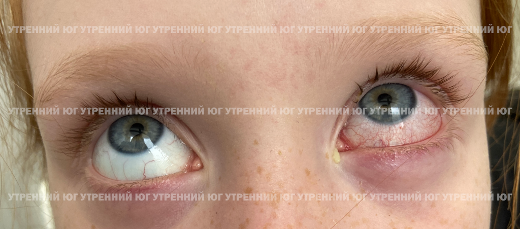 «Глаз просто залило кровью»: краснодарка рассказала, как не смогла ...