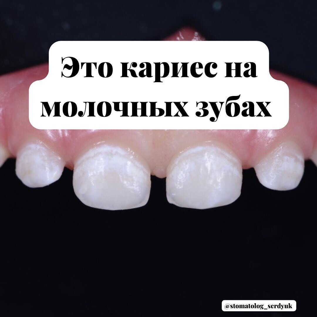 Кариес у малыша | Stomatolog_serdyuk | Дзен