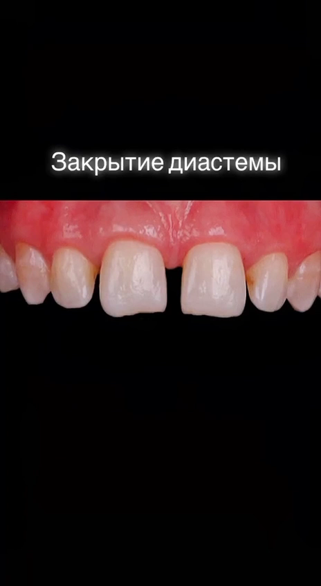1️⃣Малый размер резцов (1-2%). 2️⃣Неправильное расположение передних зубов из-за аномалий прикуса (4-7%).
3️⃣Смещение фронтальных зубов из-за повышенной нагрузки при утрате жевательных (5-8%).
4️⃣Главная причина одна (до 90%) - наличие выраженной уздечки губы, которая не дает центральным зубам стать рядом друг с другом.
