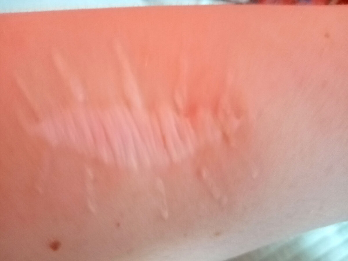 Мой Шрам 5 см. Учитывая,что меланома 1см, конечно он большой