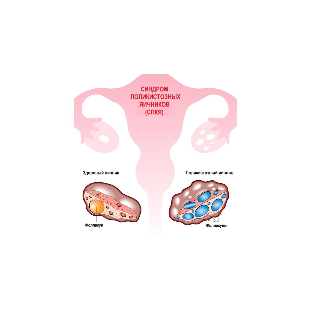 Спкя диагностика. Синдром поликистоз яичников. Синдром поликистозных яичников патогенез. Синдром поликистозных яичников диагностика.