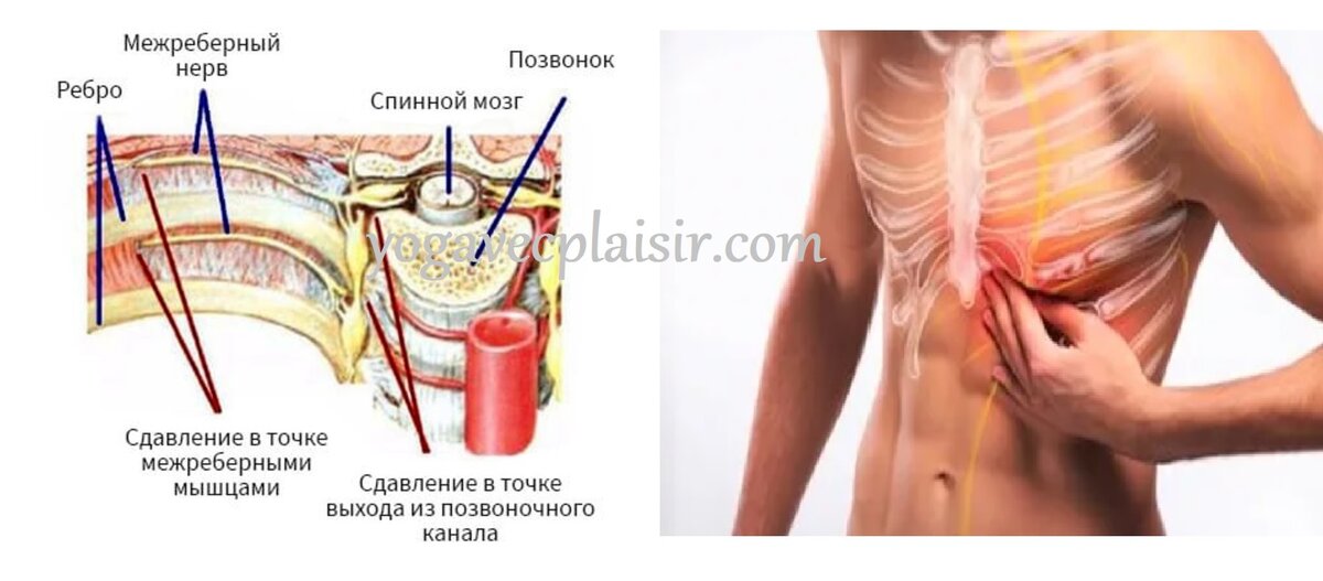 Межреберная невралгия у взрослых: симптомы, причины, лечение