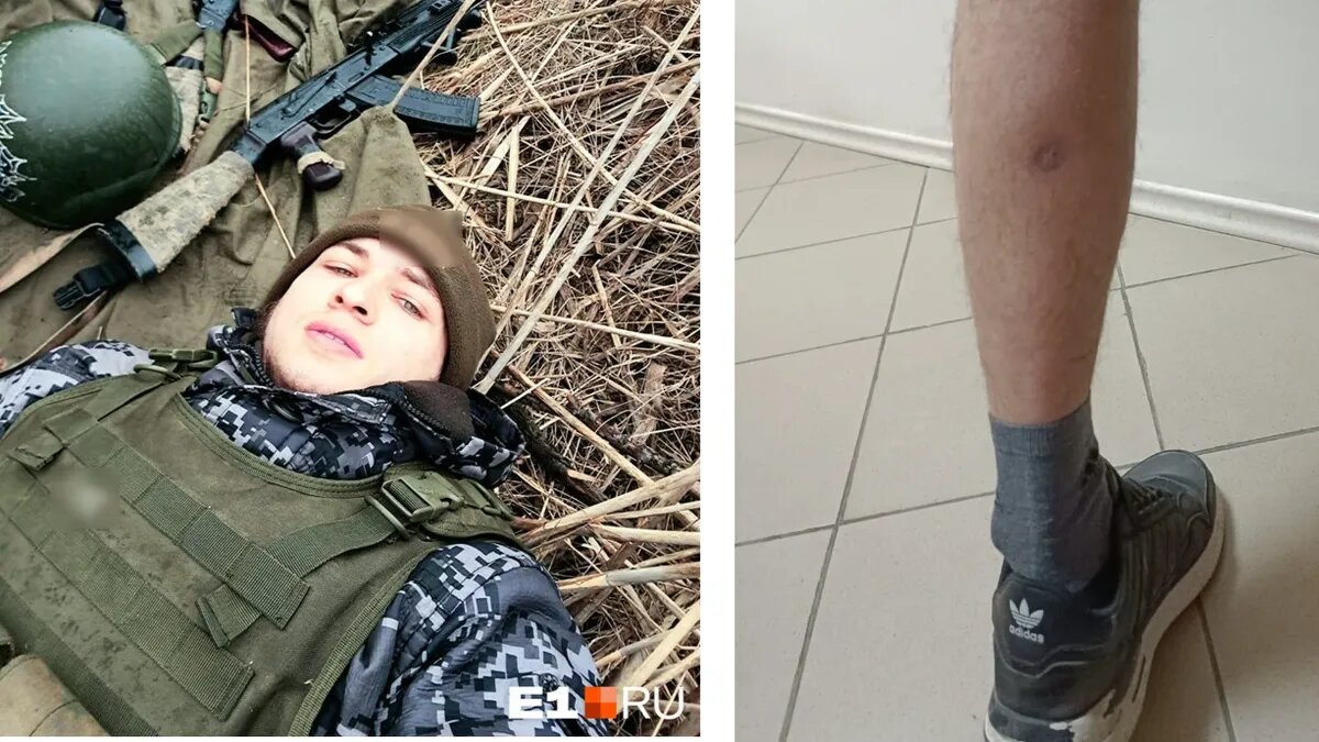 Входное отверстие зажило, но пуля осталась в теле. Фото: Александр Столбовой, e1.ru