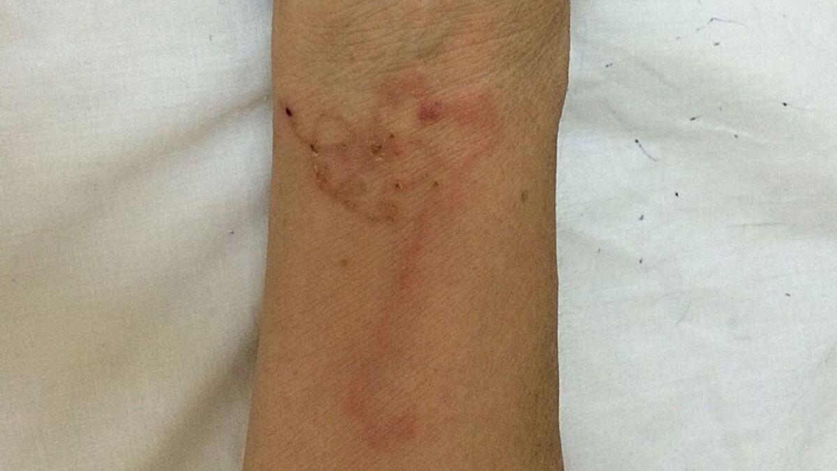 Червей можно заметить как они двигаяются под кожей женщины. Фото: Newsflash