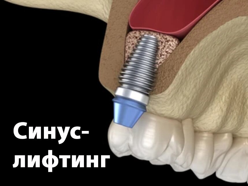 Синус лифтинг материал