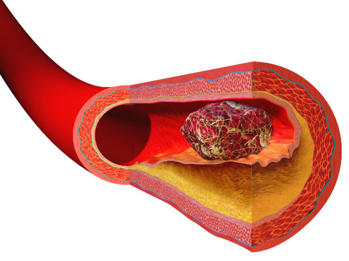 Эмболия закупорка кровеносных сосудов. Тромбоз закупорка сосудов. Тромб в кровеносном сосуде.