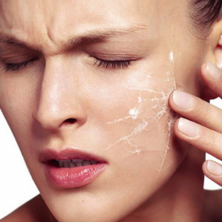 Шелушение кожи на лице: причины и как с этим бороться