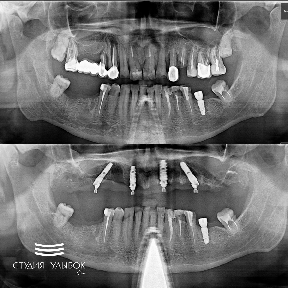 Все на четырех имплантатах