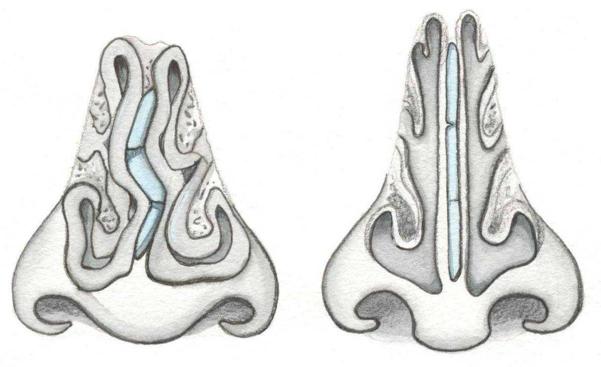 Искривление перегородки носа