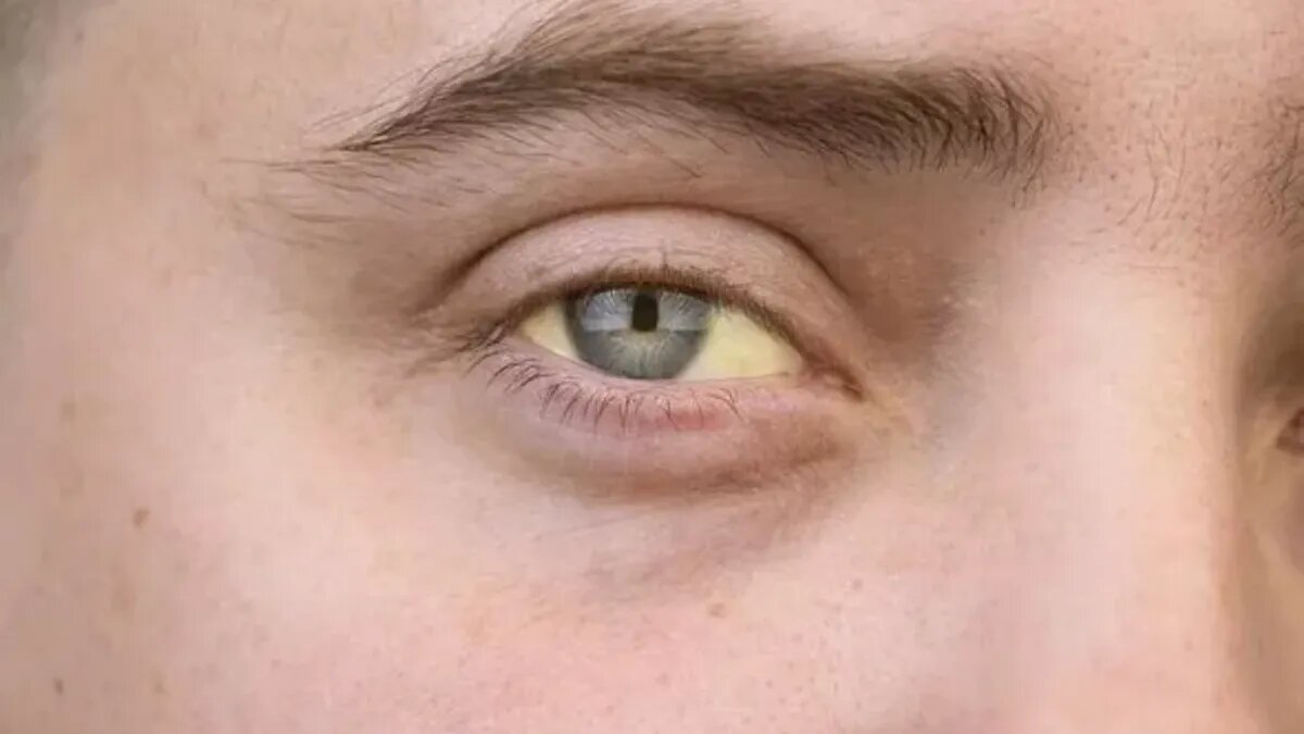 Желтуха встречается примерно у 19-40 процентов пациентов с раком печени. (Изображение: GETTY)