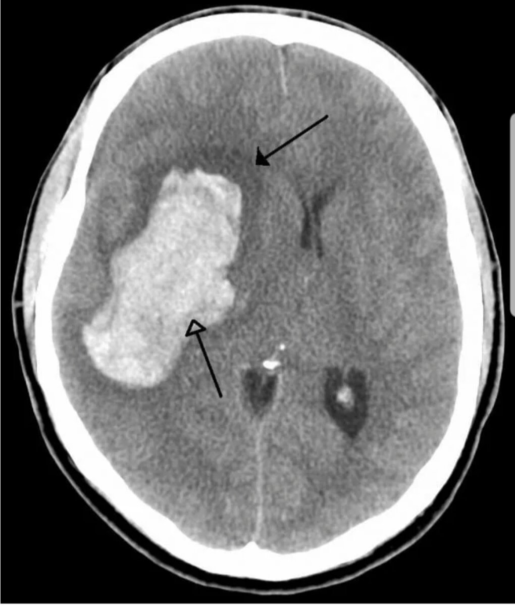 Геморрагический инсульт (фото из открытых источников)