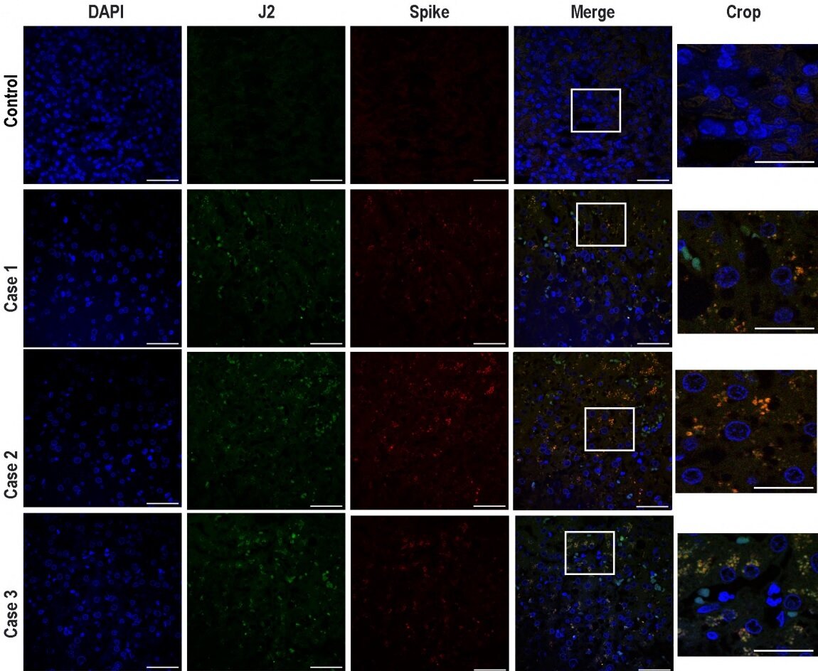     Двухцепочечная РНК (J2) и спайк-белок SARS-CoV-2 в гепатоцитах пациентов с подтвержденным ковидом Ester A. Barreto et al. / PNAS, 2023