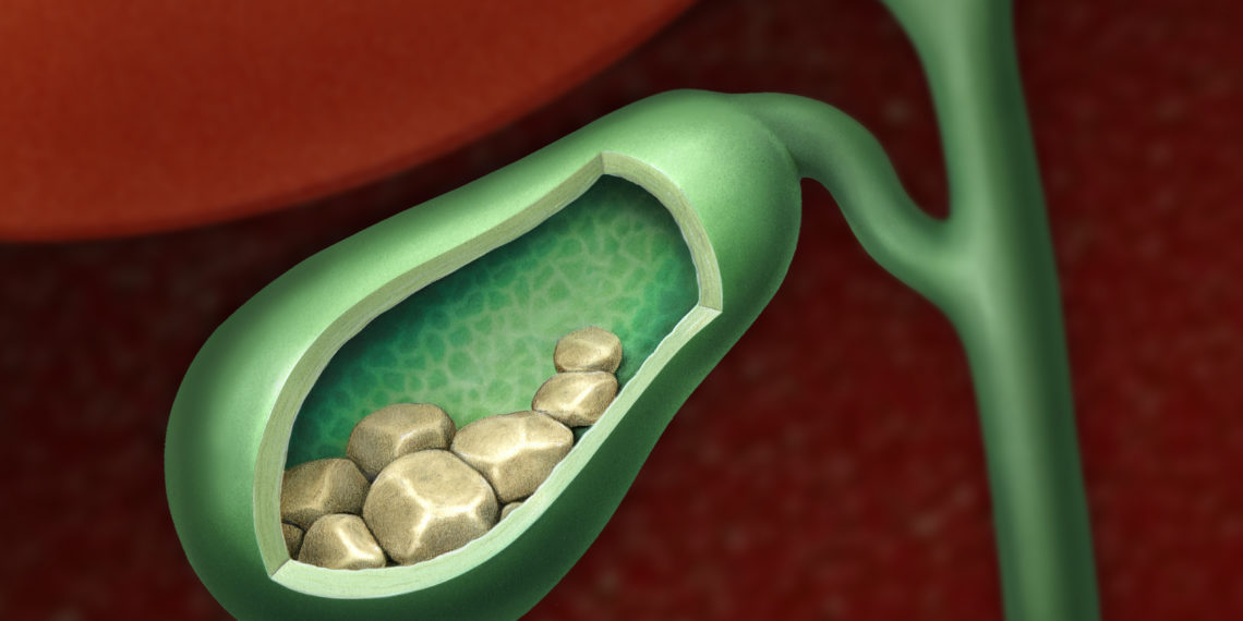 Камни в желчном пузыре у женщин. Желчекаменная болезнь камни. Желчнокаменная болезнь камни. Желчекаменная болезнь конкременты. Желчный пузырь желчнокаменная болезнь.
