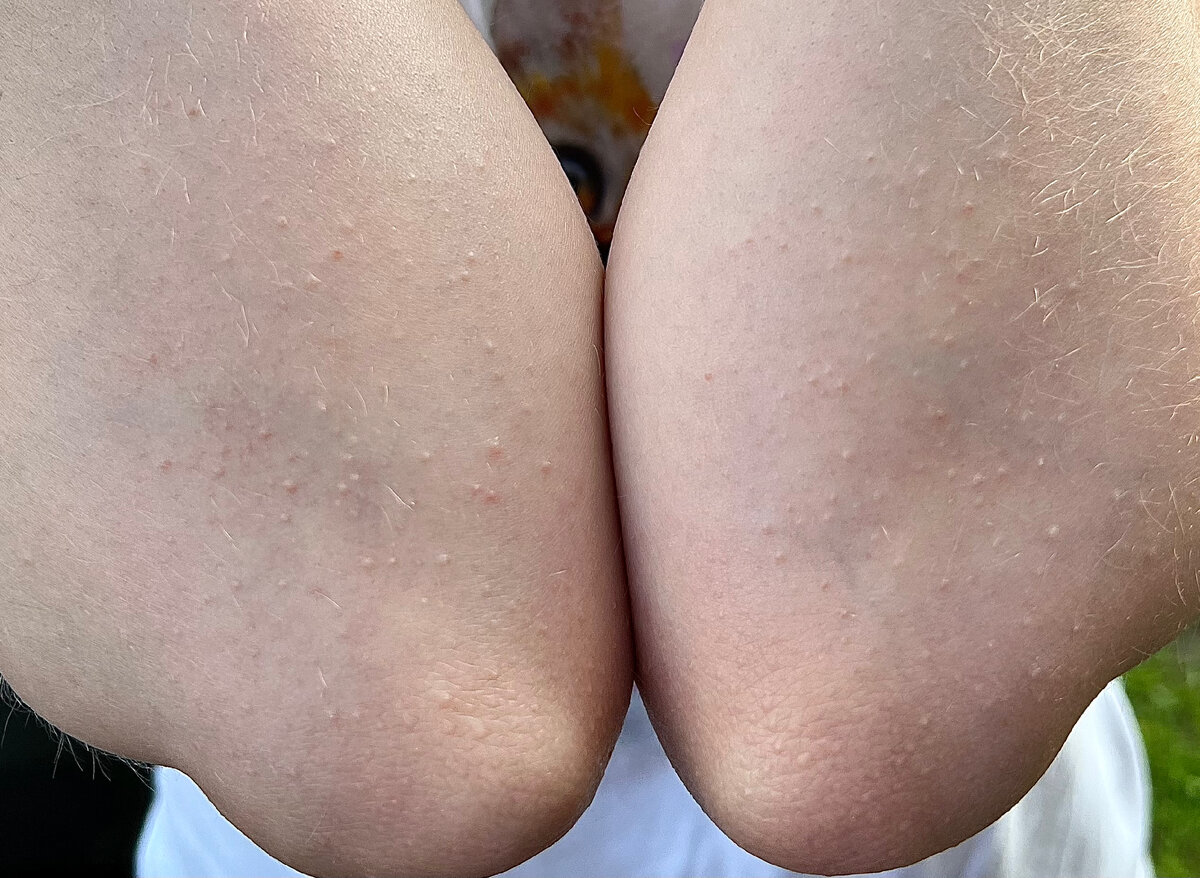 Фото из личного архива врача-дерматолога Тимачевой И.А.