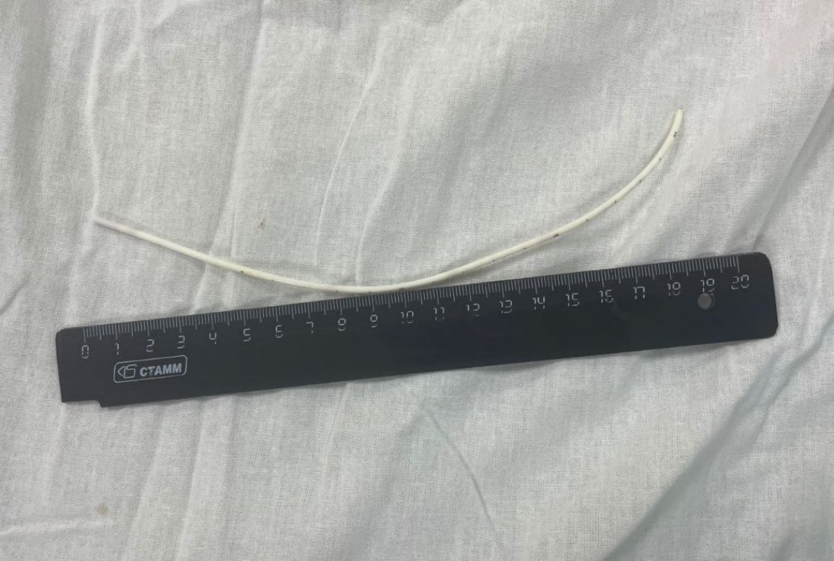    В Новороссийске из сердца женщины вытащили 20-сантиметровый катетер