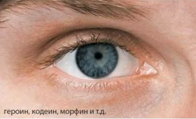 Суженный зрачок наркомана