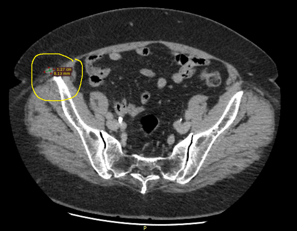 ПРОГРЕССИРОВАНИЕ МЕЛАНОМЫ IА СТАДИИ НА ФОНЕ ФИЗИОТЕРАПИИ ЧЕРЕЗ 3 МЕСЯЦА ...