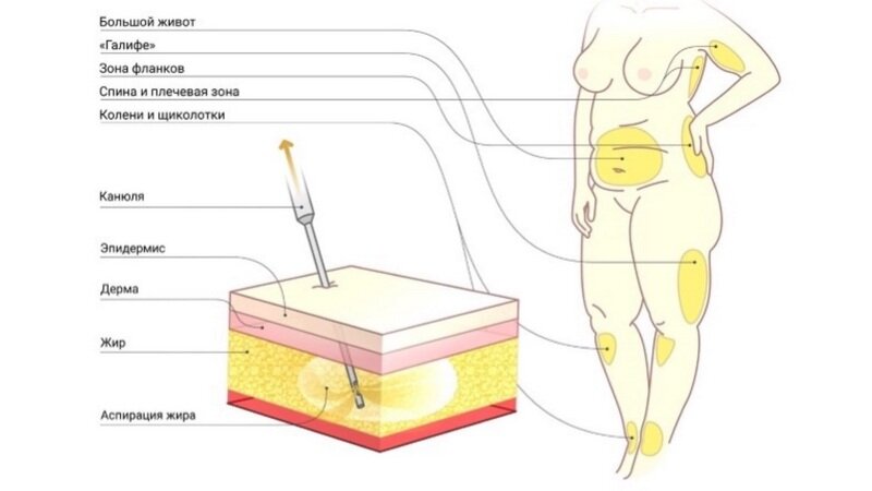 Липосакция. В иллюстративных целях. Foto by Legion Media