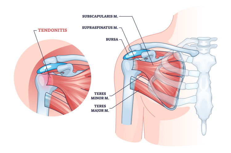 Растяжение мышц и сухожилий: лечение и симптомы