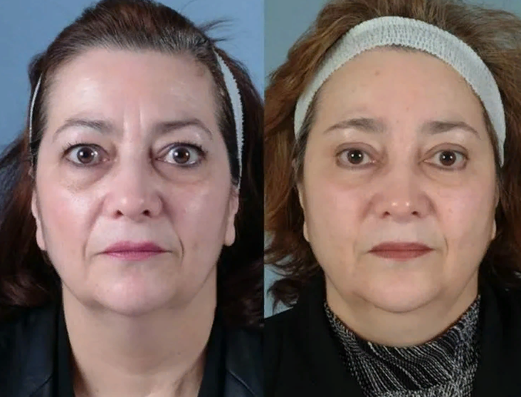 Гипотиреоз лечение у женщин после 50 лет. Гипотиреоз экзофтальм. Гипертиреоз лицо до и после.