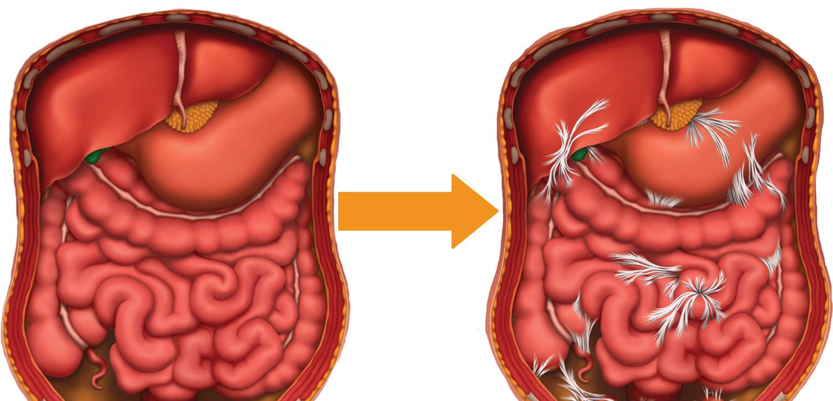 Как выглядит рак брюшной полости The Radiology Assistant : Small Bowel Tumors