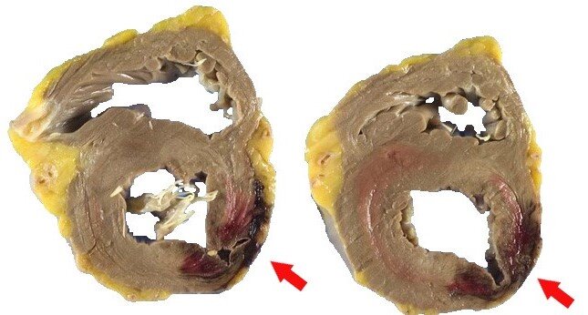 Срез сердца на вскрытии. Крупноочаговый трансмуральный инфаркт миокарда левого желудочка