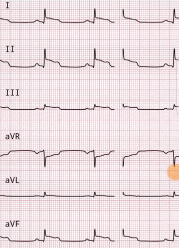 Острый коронарный синдром, зарегистрированный при помощи портативного кардиографа СмартКардио
