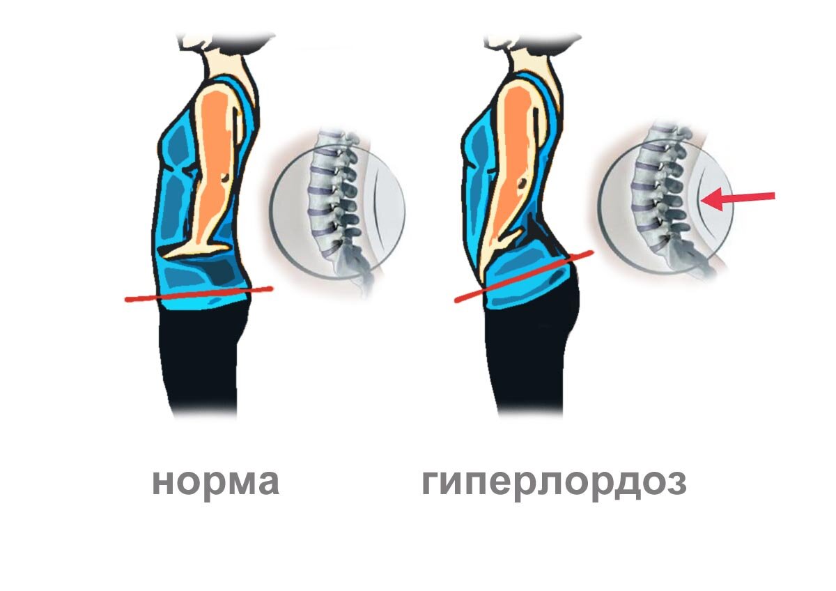 Гиперлордоз и выпирающий живот. Гиперлордоз живот. Гиперлордоз причины. Гиперлордоз у женщин.