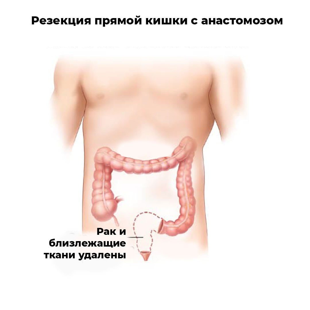 Рак кишечника: со стомой или без? | Тулина Инна Андреевна | Дзен