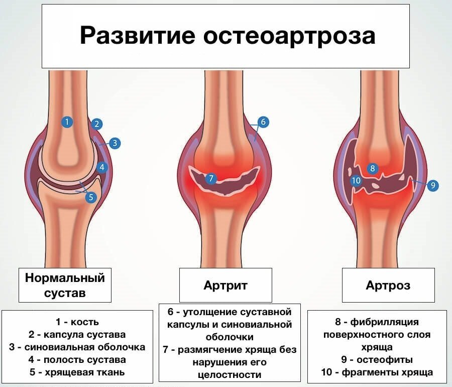Остеоартроз что это такое как лечить. Схема развития деформирующего остеоартроза. Классификация остеоартроза коленного сустава. Деформирующий артроз коленного сустава схема. Первичный идиопатический остеоартроз.