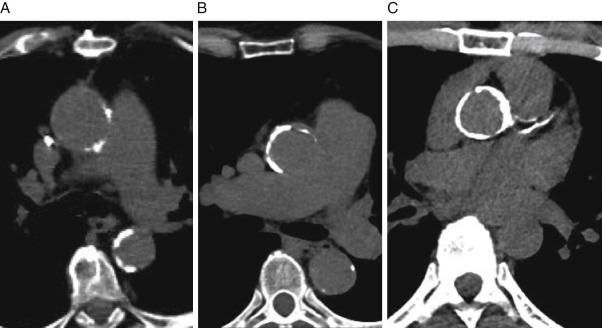Только полюбуйтесь на эту костяную трубочку, в которую превратилась аорта.