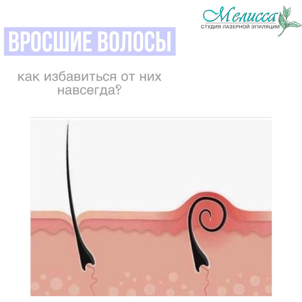 Лазерная эпиляция в Чайковском 