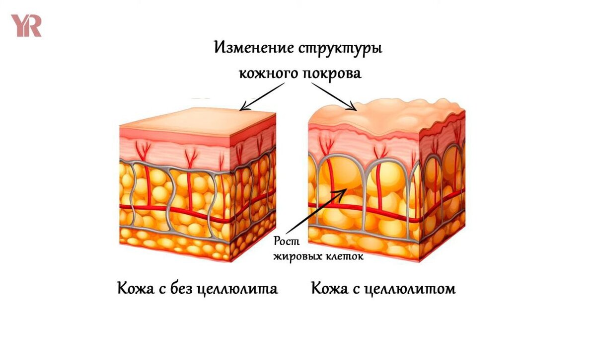 Как выглядит целлюлит под кожей Целлюлит 1 стадия