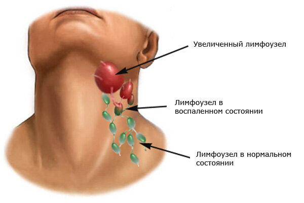 Причины воспаления лимфоузлов на шее у ребенка