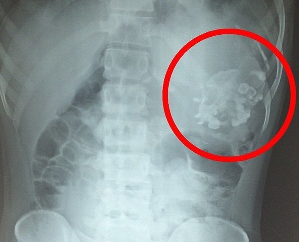 21-летний Нарендра Кумар с детства страдал всевозможными недомоганиями, включая потерю веса.