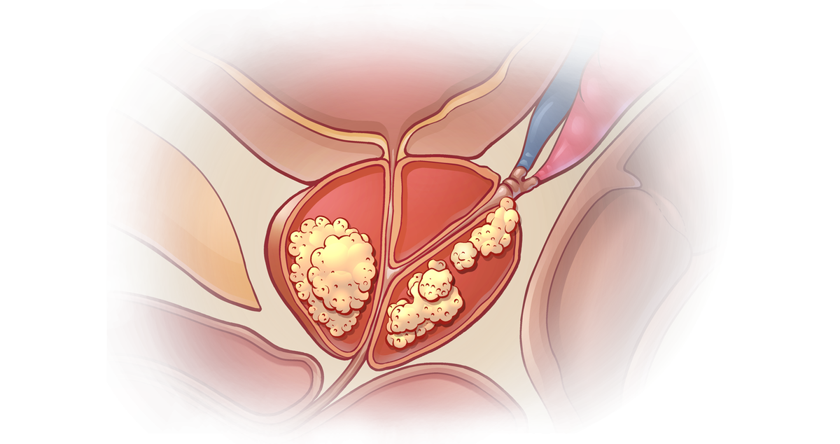 Рак простаты