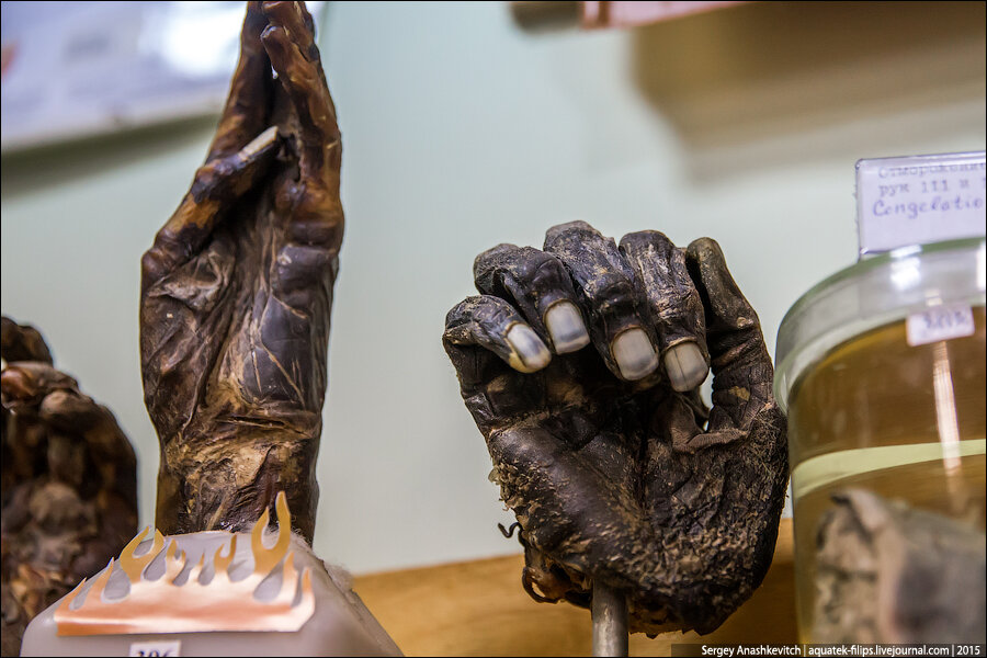 Руки человека, сгоревшего во время пожара. Левая рука так и осталась в положении, в котором она держала сигарету. Классическая картина. Ее "владелец", будучи сильно пьяным, курил в постели... И уснул