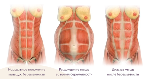 Диастаз мышц живота у мужчин