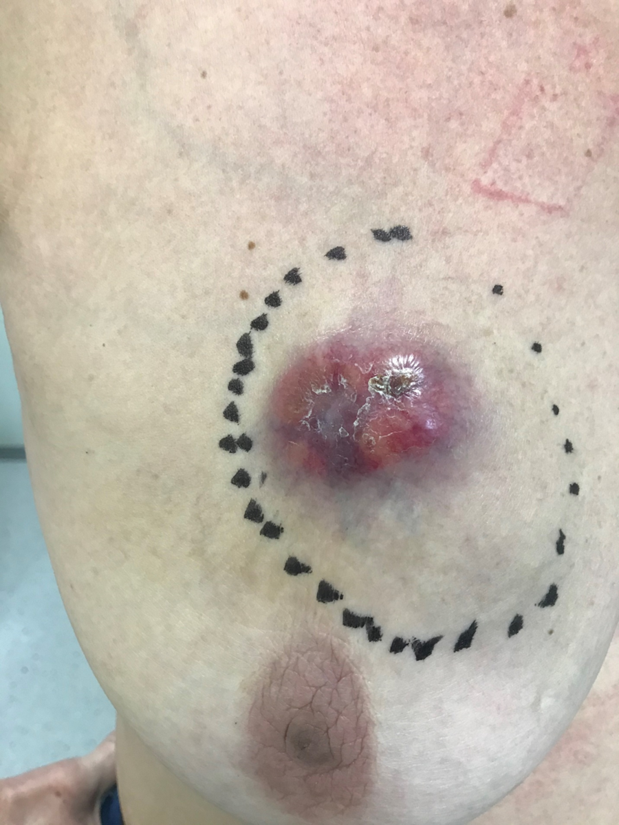 Пунктиром обрисована пальпируемая опухоль. 