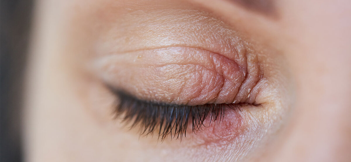 Демодекоз глаз: причины, симптомы и лечение