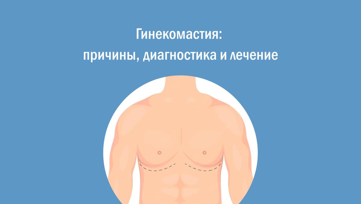 Гинекомастия: причины, диагностика и лечение | Скандинавский Центр Здоровья  | Дзен