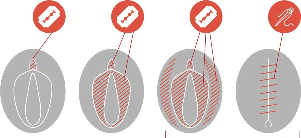 Схема женского обрезания из сети интернет