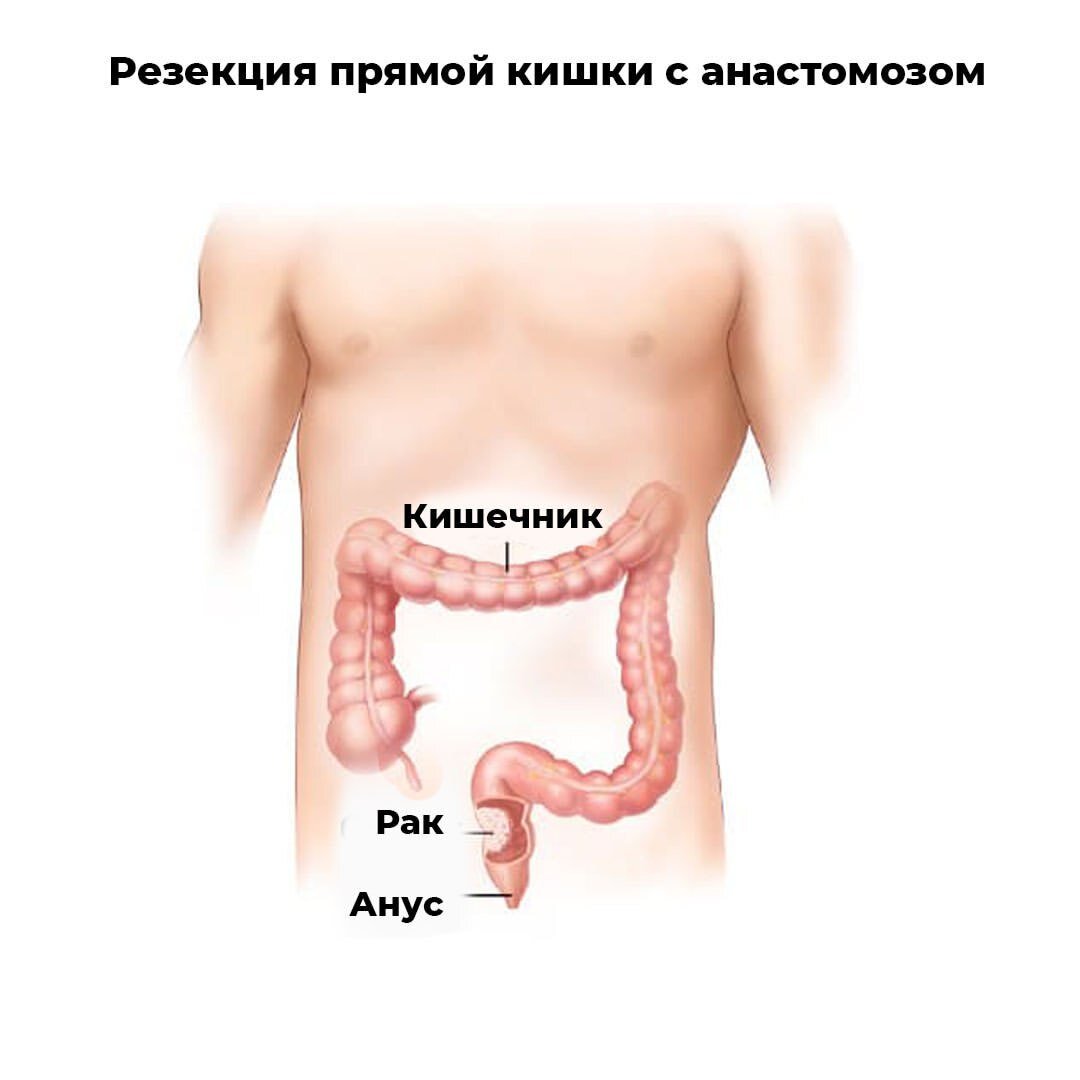 Температура при онкологии кишечника