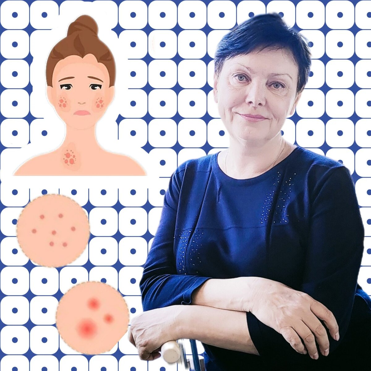 Чем лечить аллергическую сыпь? Советует врач-аллерголог Ирина ФЕДОТОВА ...