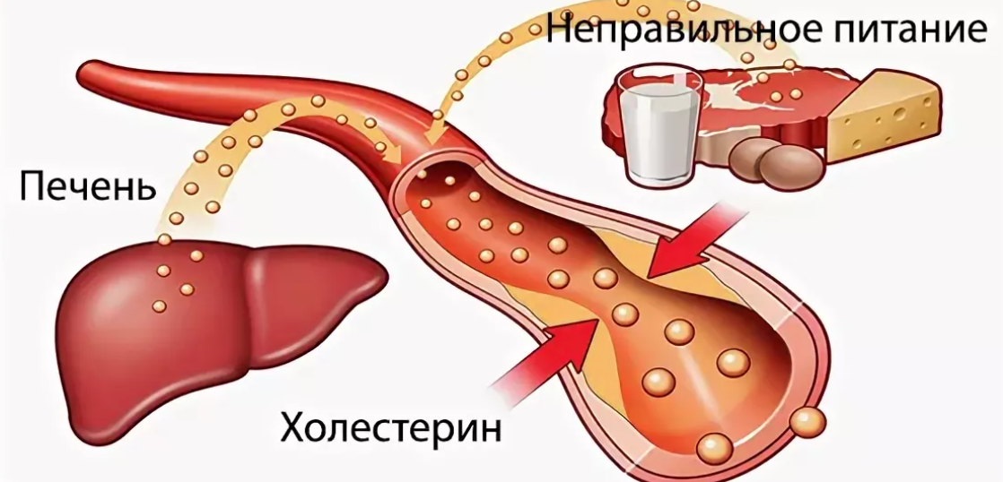 Повышенный холестерин и печень