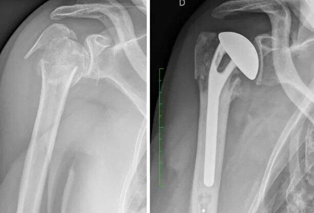 Однополюсный эндопротез применен при оскольчатом переломе головки и шейки плечевой кости