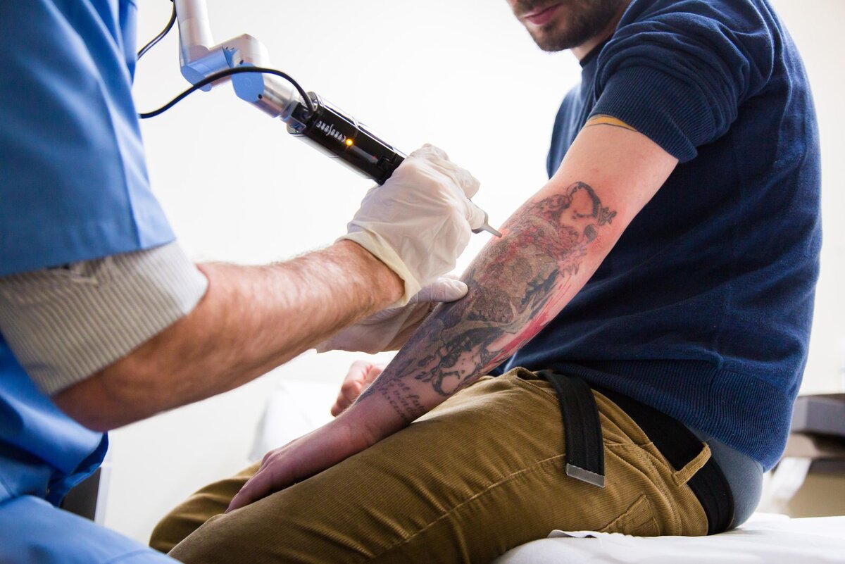 Удаление тату лазером. - удаление цветной татуировки в Москве | L'Art Clinic