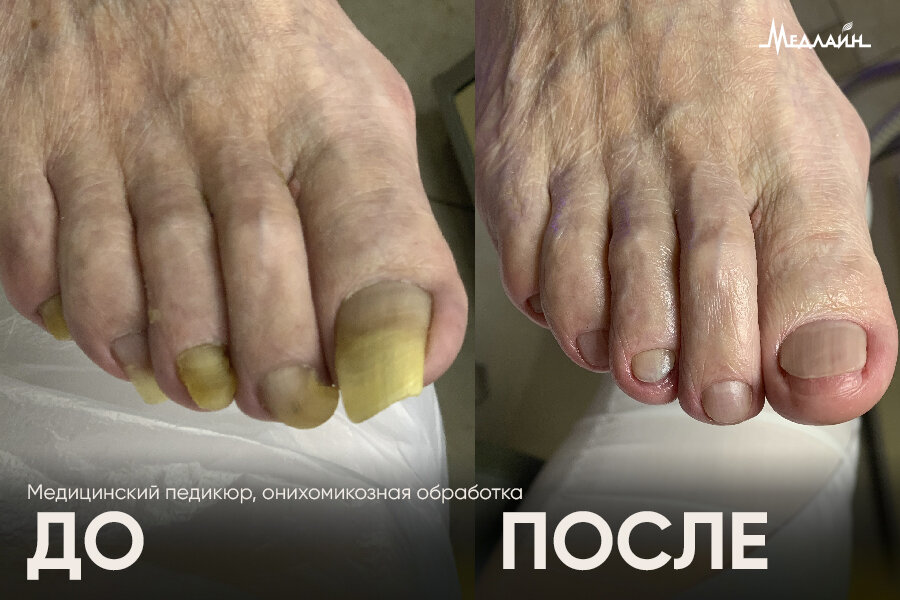 В МедЛайн мы решаем все проблемы ногтей и стоп, в том числе и утолщение ногтевой пластины :) 