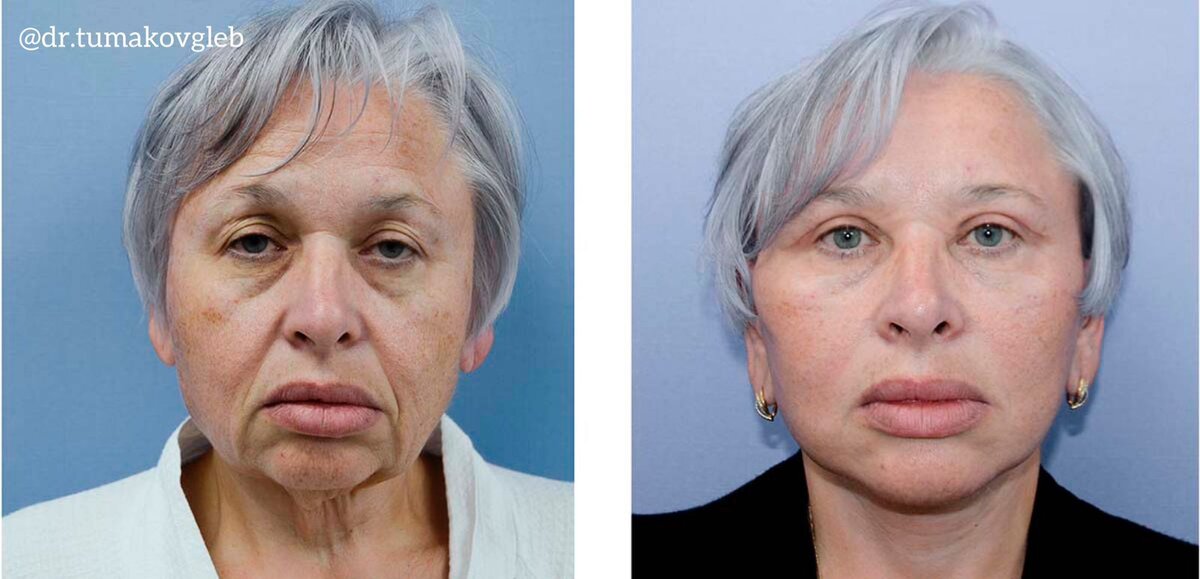 Круговая подтяжка лица и шеи, круговая блефаропластика. С момента операции прошло 20 дней.